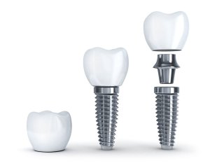 A Step by Step Guide to Dental Implants