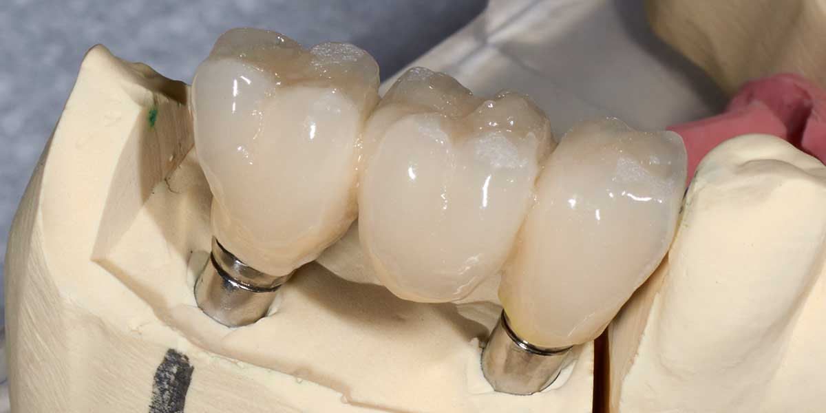 Aurora Dental Implant Supported Bridges