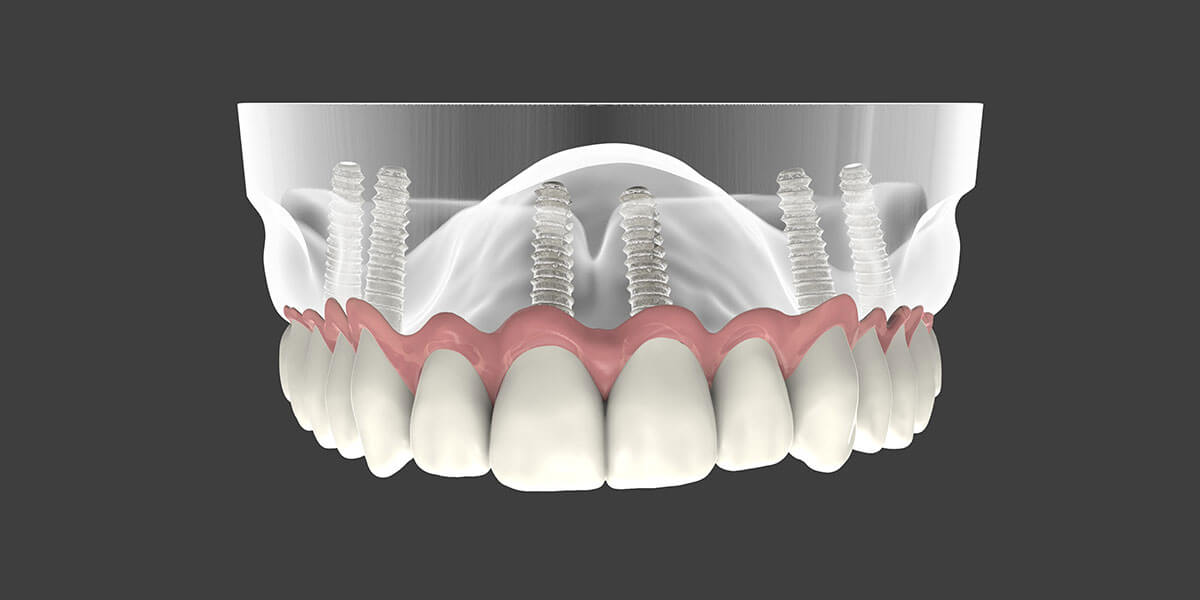 Aurora Dental Implant Supported Dentures