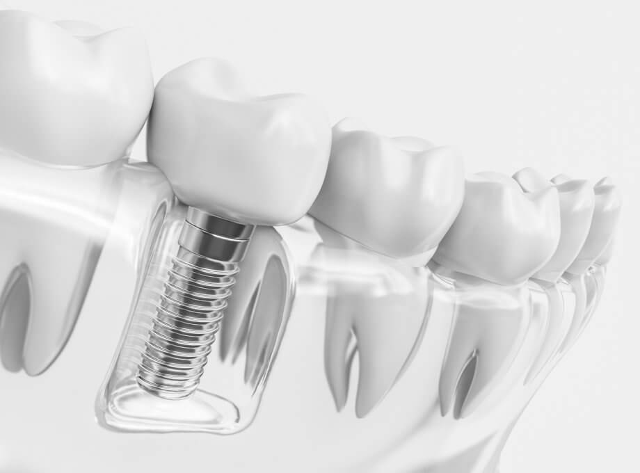 The Pros And Cons Of Dental Implants & Dental Crowns | Aurora Dental