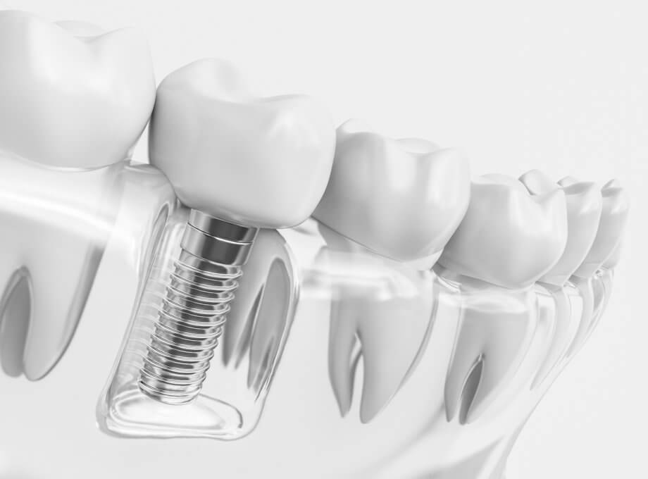 Close Up Of Dental Implant