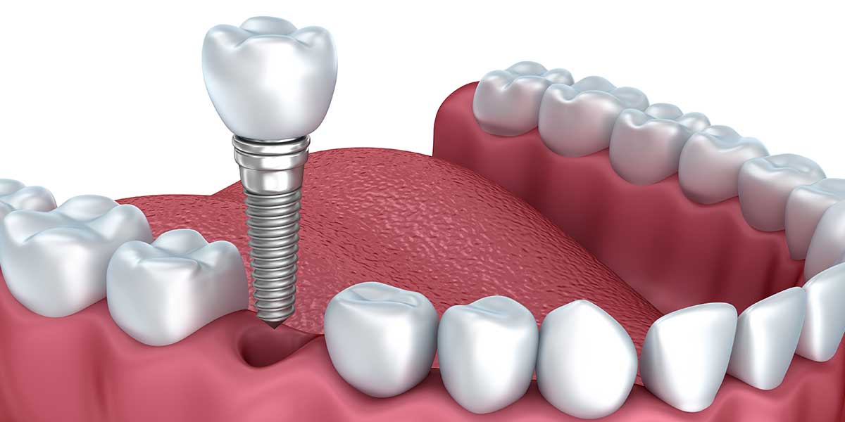 Single Dental Implants in Aurora, OH