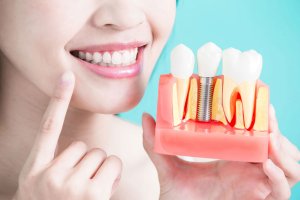 Dental Implant Pain and Recovery