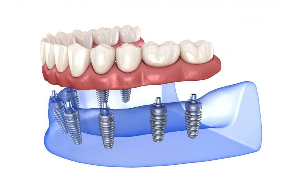 example of dental implants