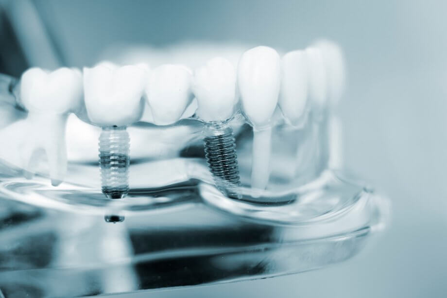 A model of dental implants