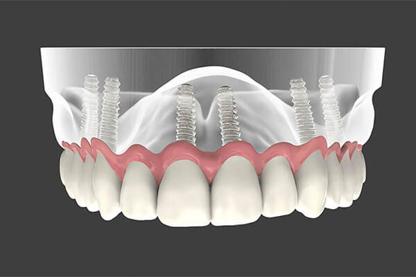 Dental Implants in Aurora, OH